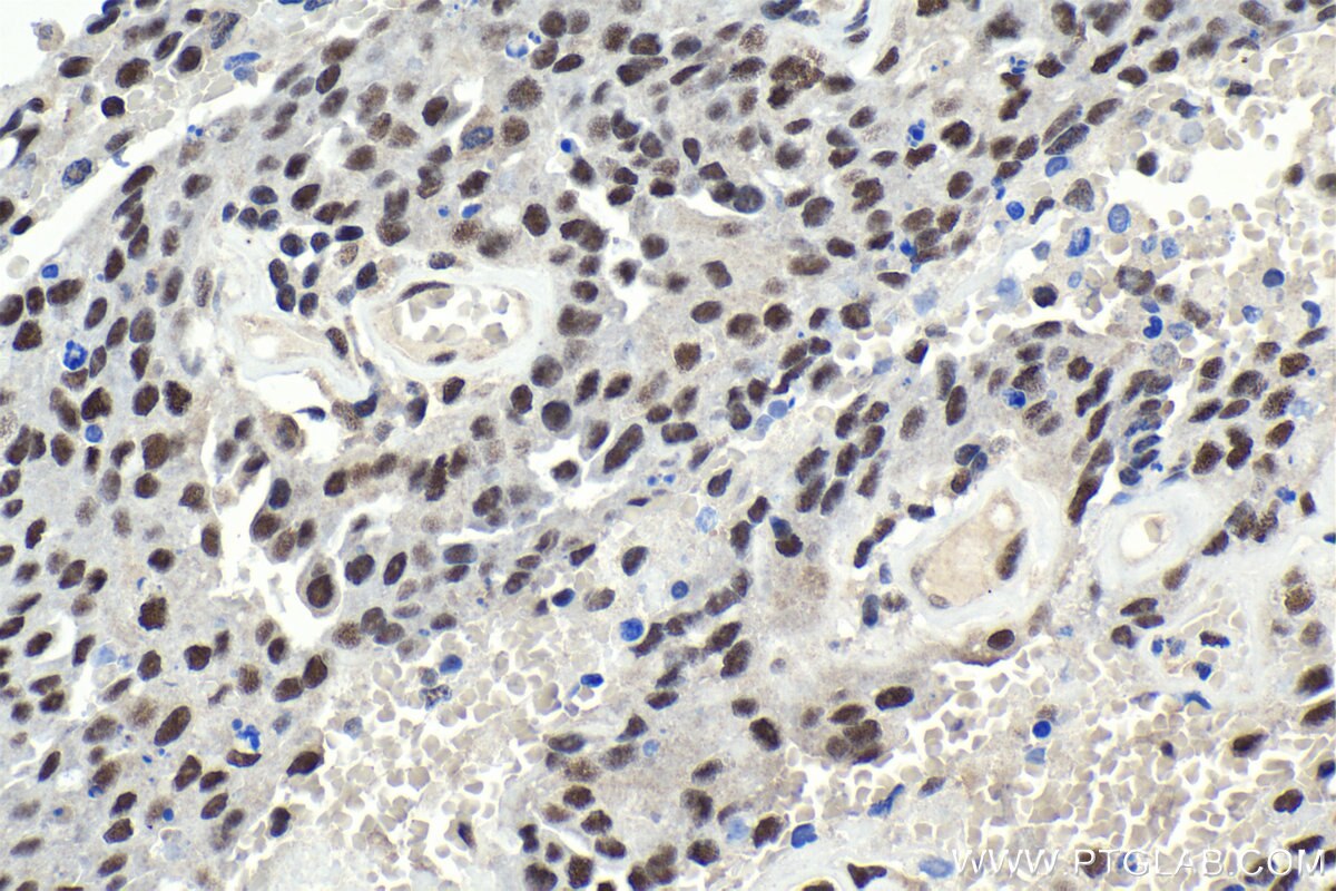 IHC staining of human ovary tumor using 25138-1-AP