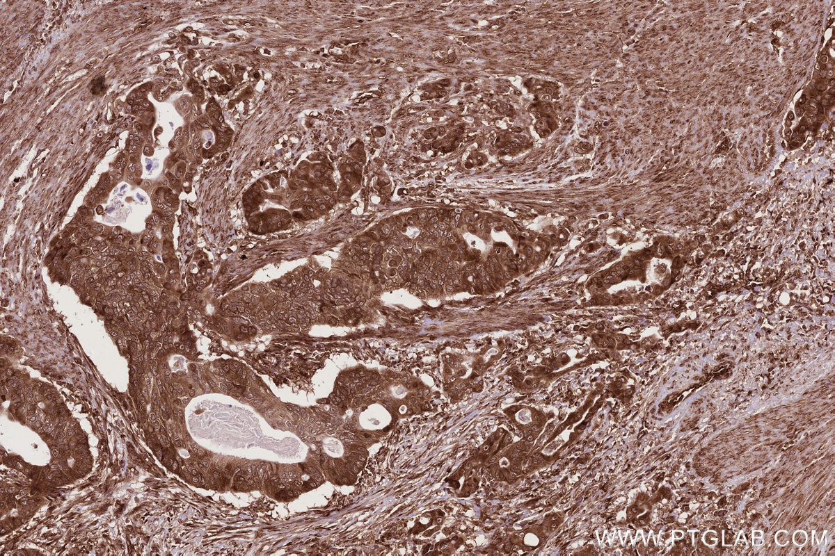 IHC staining of human stomach cancer using 27106-1-AP Immunohistochemistry (IHC) staining of human stomach cancer tissue using CCDC124 Polyclonal antibody (27106-1-AP)