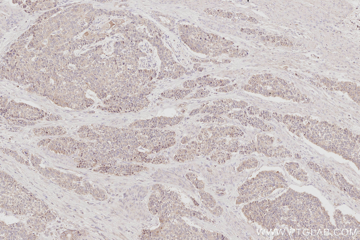 Immunohistochemistry (IHC) staining of human stomach cancer tissue using CEP83 Polyclonal antibody (26013-1-AP)