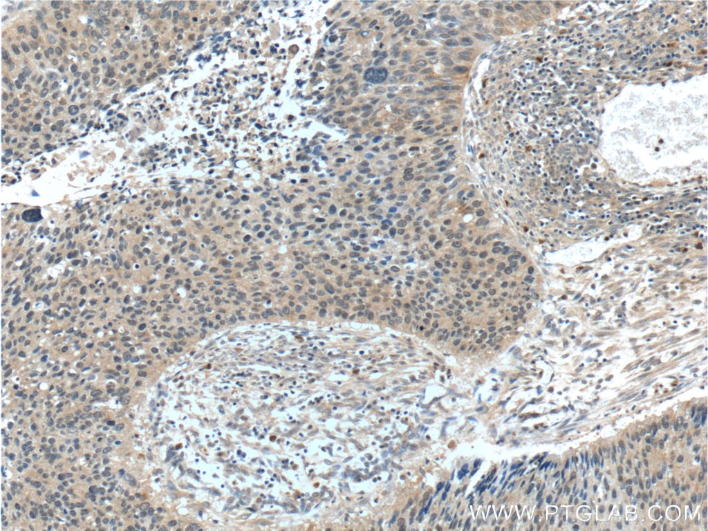Immunohistochemistry (IHC) staining of human cervical cancer tissue using CWC25 Polyclonal antibody (24416-1-AP)