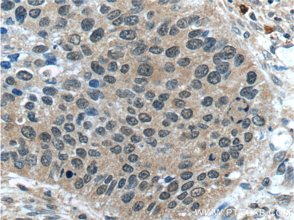 Immunohistochemistry (IHC) staining of human cervical cancer tissue using CWC25 Polyclonal antibody (24416-1-AP)