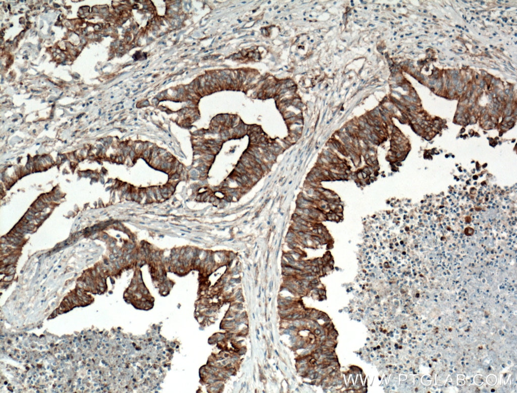 Immunohistochemistry (IHC) staining of human pancreas cancer tissue using HAUS1 Polyclonal antibody (11094-2-AP)