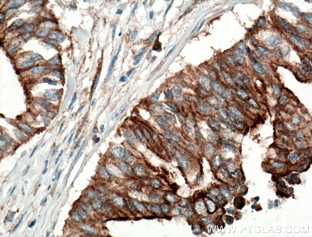 Immunohistochemistry (IHC) staining of human pancreas cancer tissue using HAUS1 Polyclonal antibody (11094-2-AP)