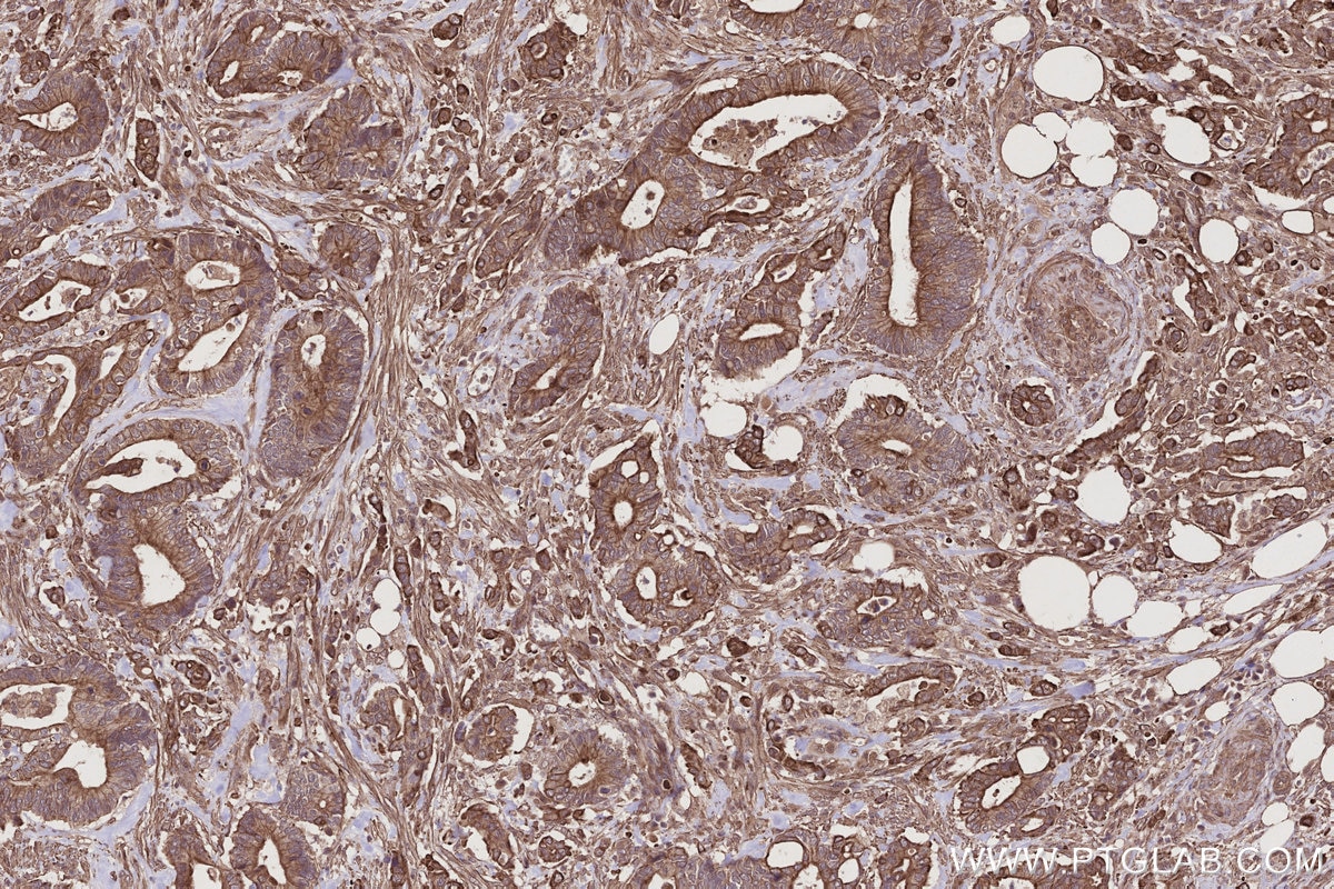Immunohistochemistry (IHC) staining of human rectal cancer tissue using HAUS1 Polyclonal antibody (11094-2-AP)