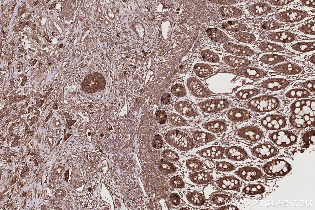 Immunohistochemistry (IHC) staining of human rectal cancer tissue using HAUS1 Polyclonal antibody (11094-2-AP)