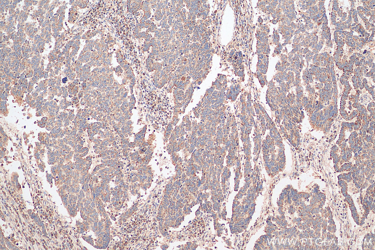 Immunohistochemistry (IHC) staining of human ovary tumor tissue using CCDC51 Polyclonal antibody (20465-1-AP)