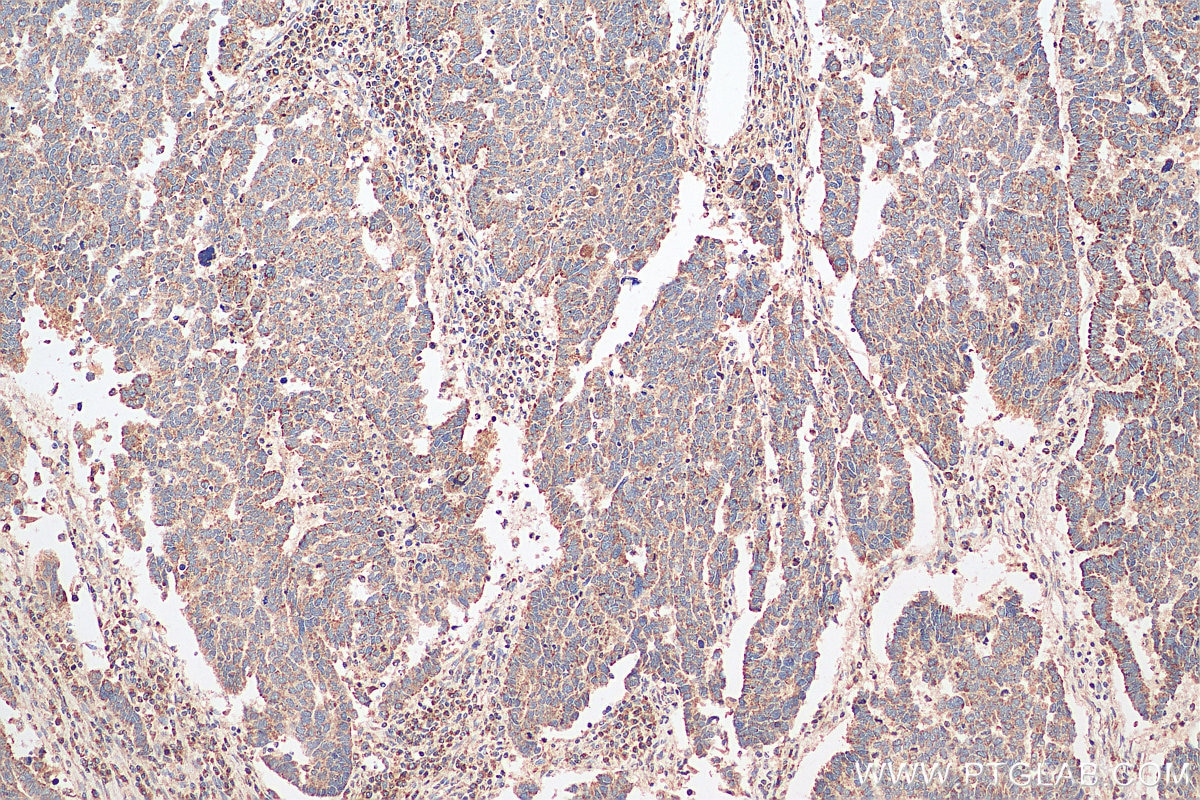 IHC staining of human ovary tumor using 20465-1-AP