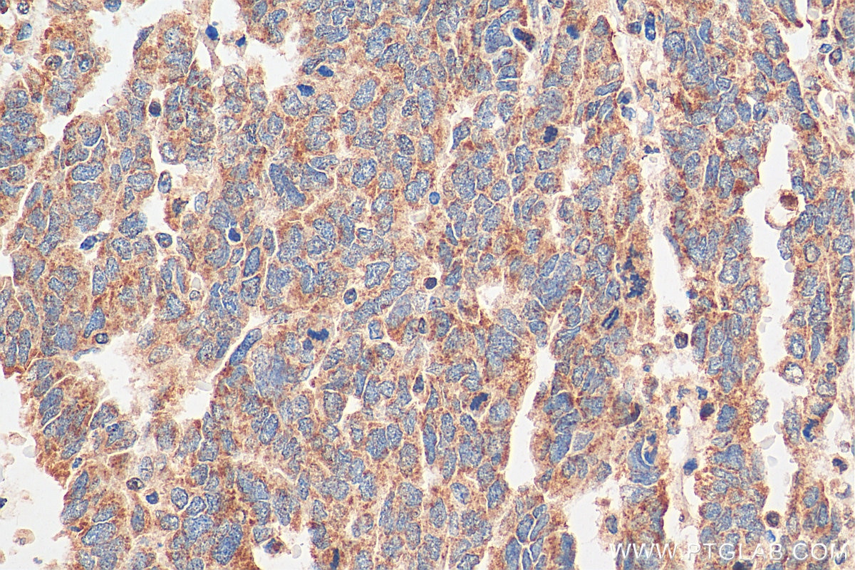 Immunohistochemistry (IHC) staining of human ovary tumor tissue using CCDC51 Polyclonal antibody (20465-1-AP)