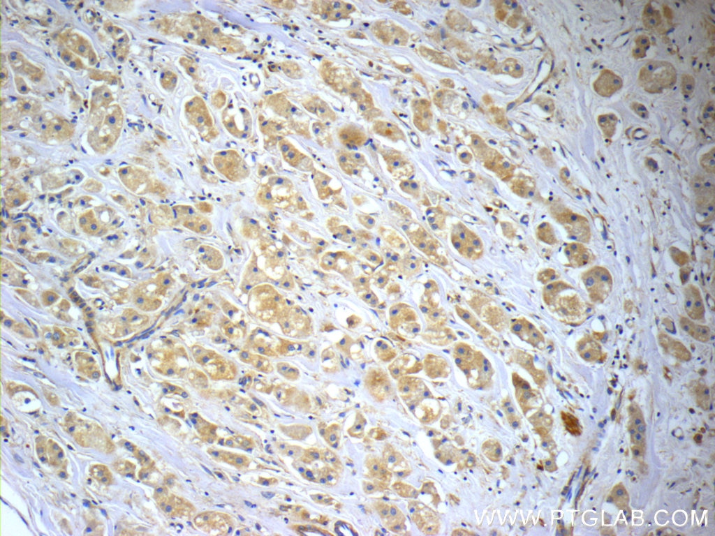 Immunohistochemistry (IHC) staining of human breast cancer tissue using CCDC53 Polyclonal antibody (24445-1-AP)