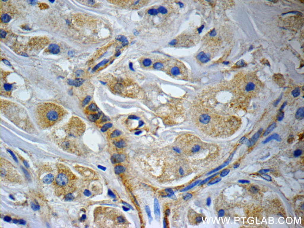 Immunohistochemistry (IHC) staining of human breast cancer tissue using CCDC53 Polyclonal antibody (24445-1-AP)