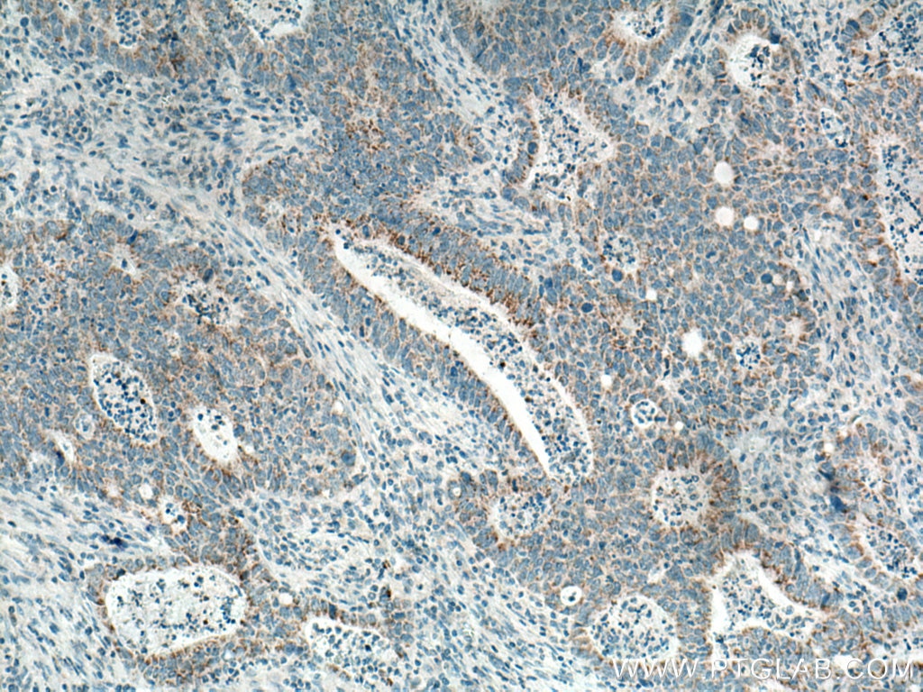 Immunohistochemistry (IHC) staining of human colon cancer tissue using CCDC56 Polyclonal antibody (20427-1-AP)