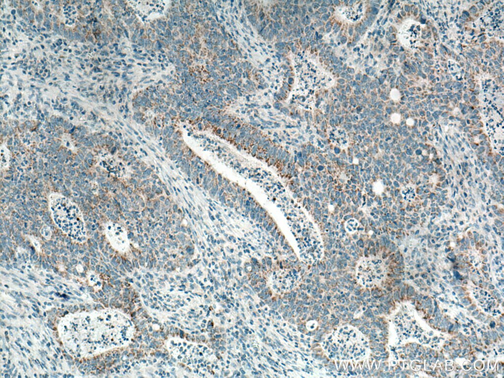 Immunohistochemistry (IHC) staining of human colon cancer tissue using CCDC56/COA3 Polyclonal antibody (20427-1-AP)