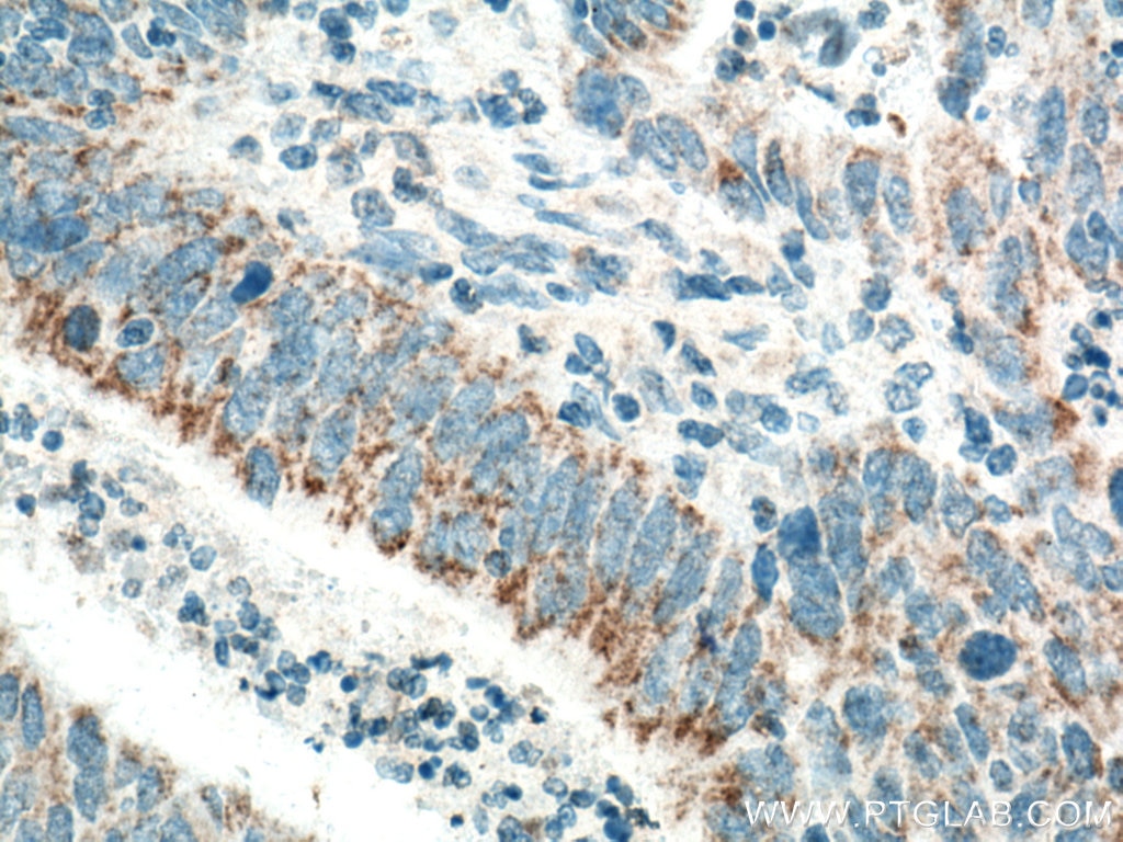 Immunohistochemistry (IHC) staining of human colon cancer tissue using CCDC56 Polyclonal antibody (20427-1-AP)