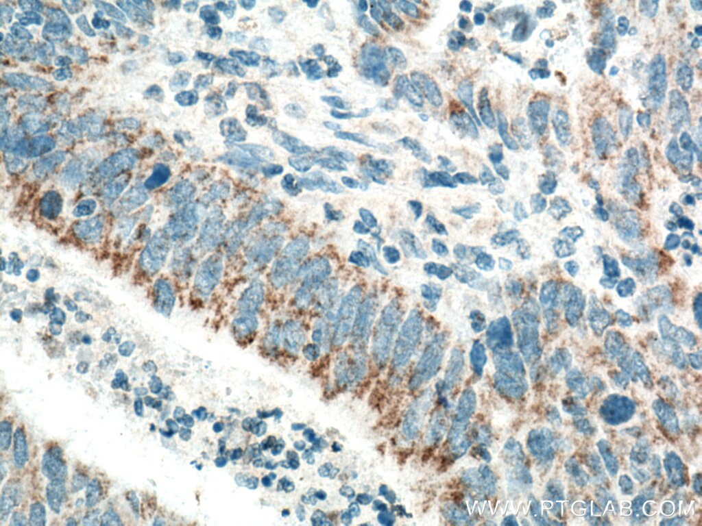 Immunohistochemistry (IHC) staining of human colon cancer tissue using CCDC56/COA3 Polyclonal antibody (20427-1-AP)