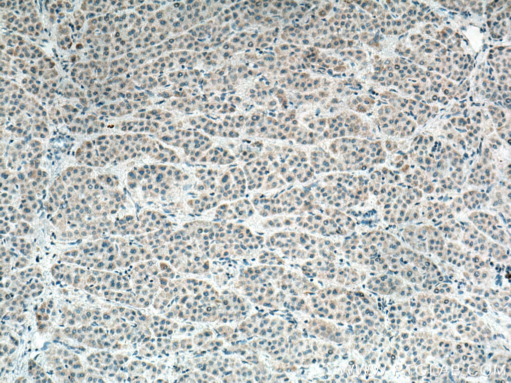 IHC staining of human liver cancer using 20427-1-AP