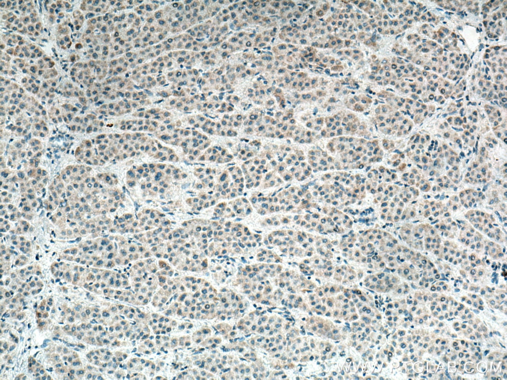 Immunohistochemistry (IHC) staining of human liver cancer tissue using CCDC56/COA3 Polyclonal antibody (20427-1-AP)