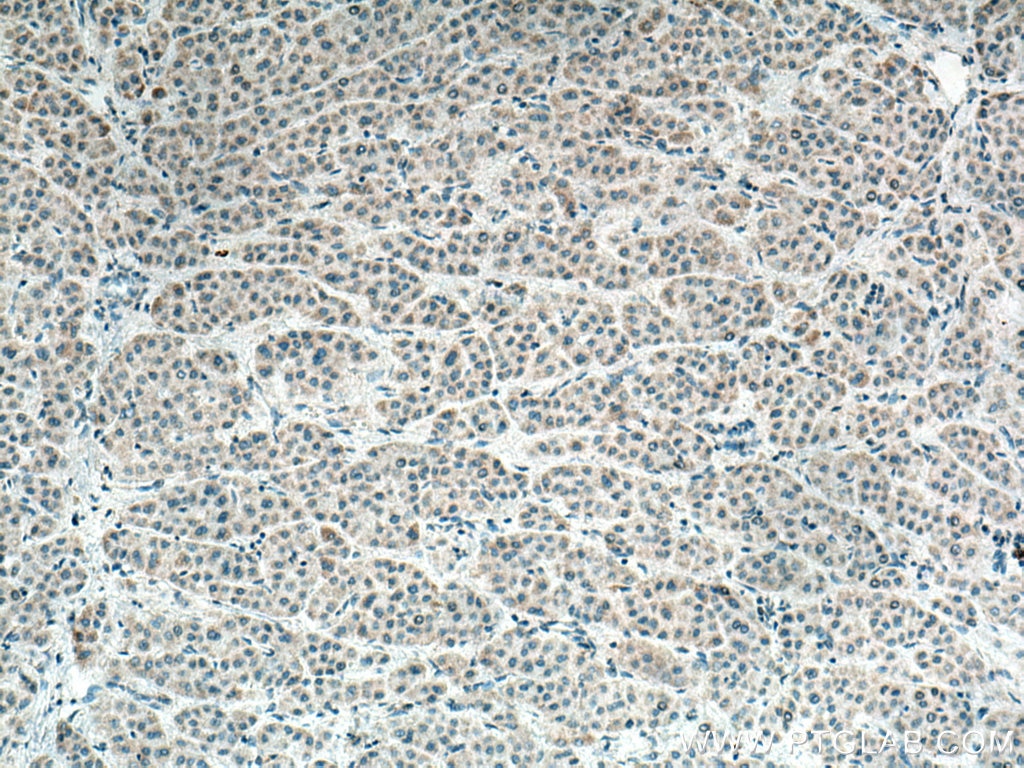 Immunohistochemistry (IHC) staining of human liver cancer tissue using CCDC56 Polyclonal antibody (20427-1-AP)