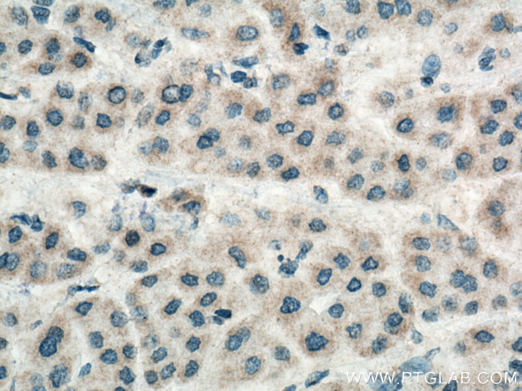 Immunohistochemistry (IHC) staining of human liver cancer tissue using CCDC56 Polyclonal antibody (20427-1-AP)