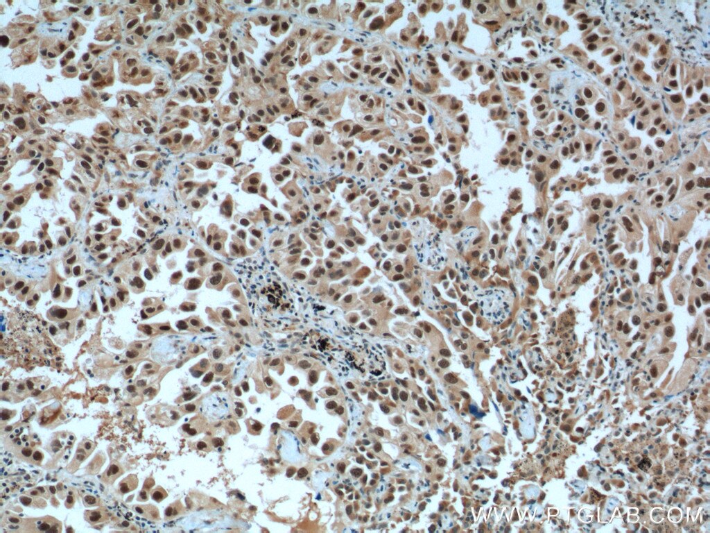 Immunohistochemistry (IHC) staining of human lung cancer tissue using CCDC59 Polyclonal antibody (26387-1-AP)