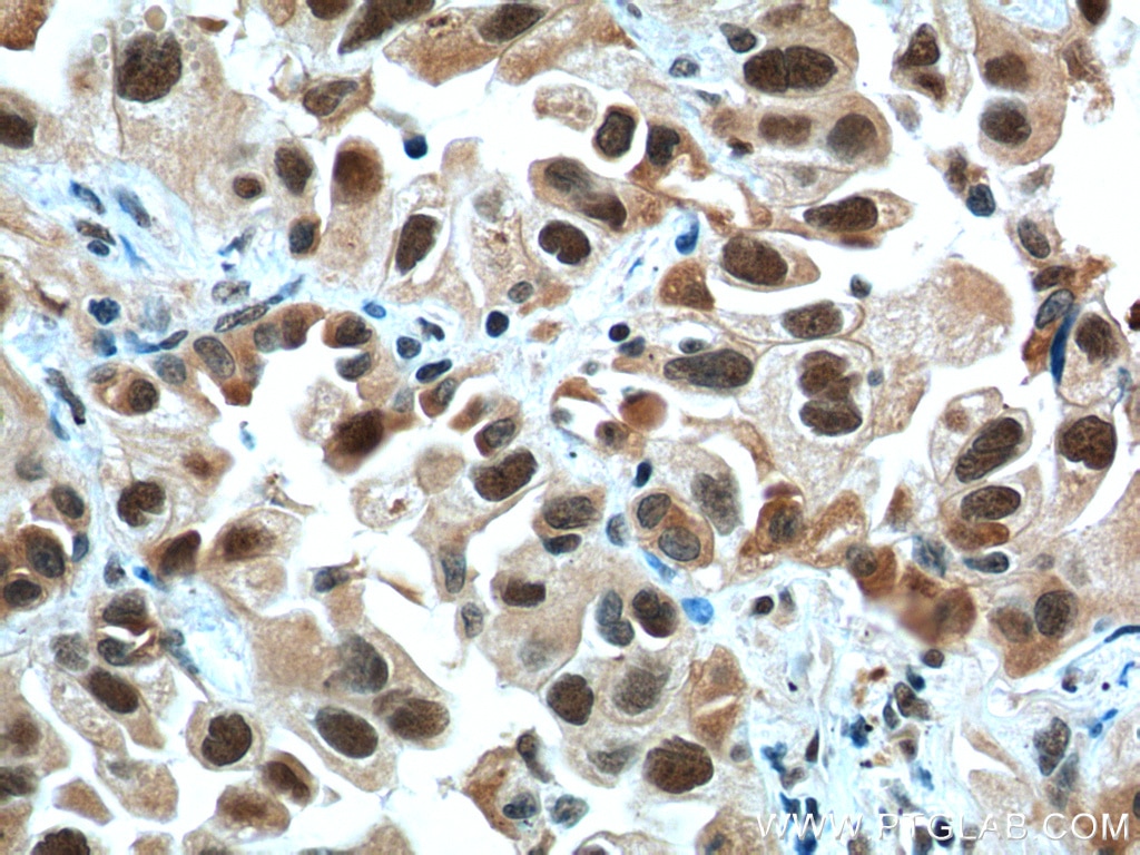 Immunohistochemistry (IHC) staining of human lung cancer tissue using CCDC59 Polyclonal antibody (26387-1-AP)