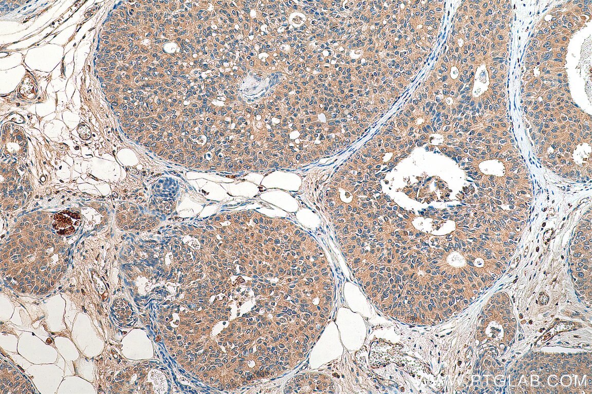 Immunohistochemistry (IHC) staining of human breast cancer tissue using CCDC64B Polyclonal antibody (22770-1-AP)