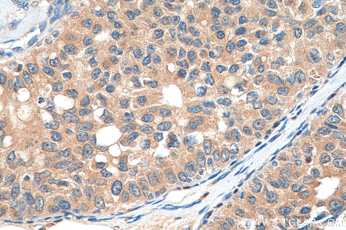 Immunohistochemistry (IHC) staining of human breast cancer tissue using CCDC64B Polyclonal antibody (22770-1-AP)