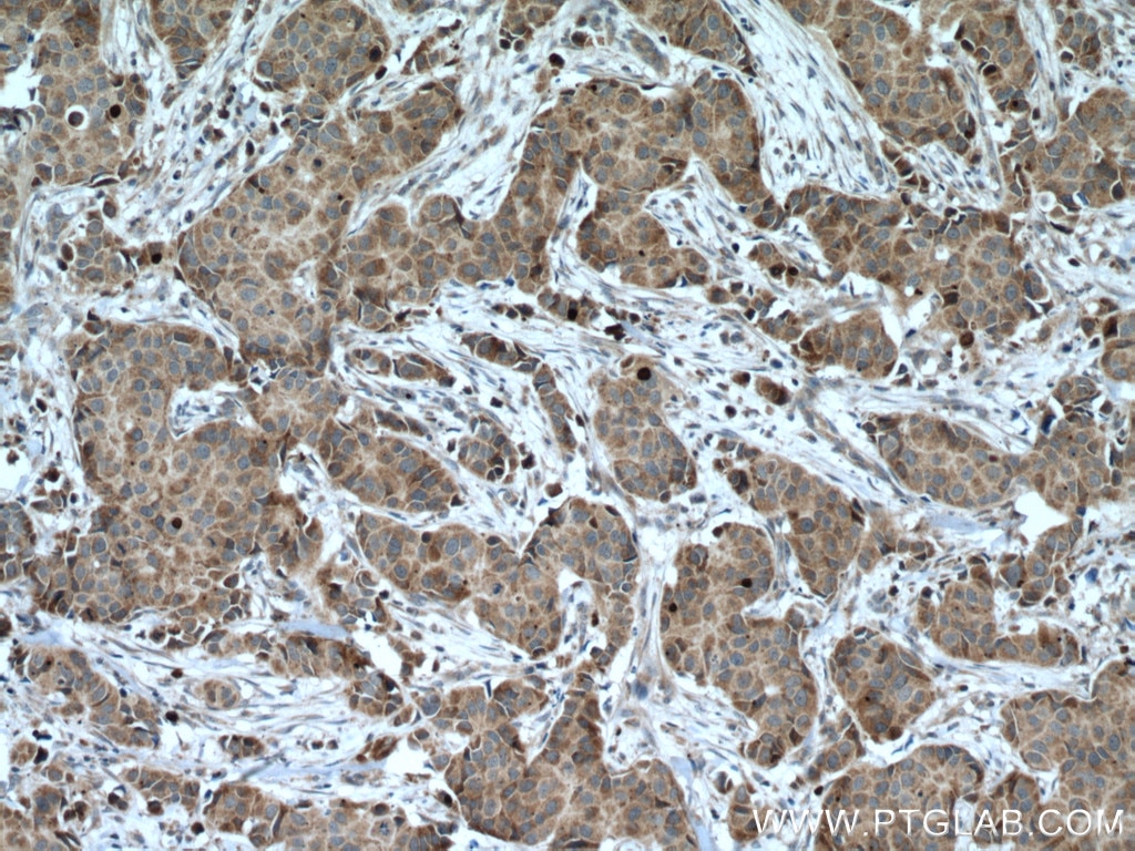 Immunohistochemistry (IHC) staining of human breast cancer tissue using CCDC71 Polyclonal antibody (28152-1-AP)