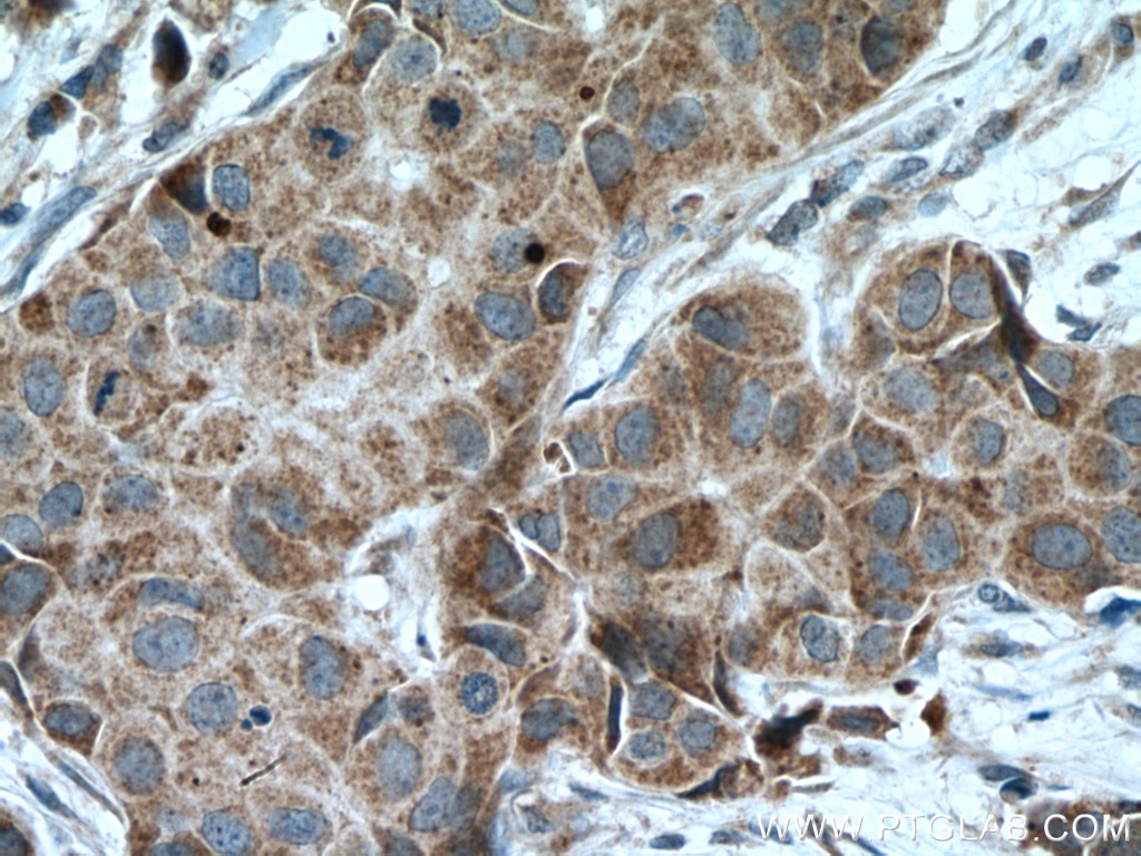 Immunohistochemistry (IHC) staining of human breast cancer tissue using CCDC71 Polyclonal antibody (28152-1-AP)