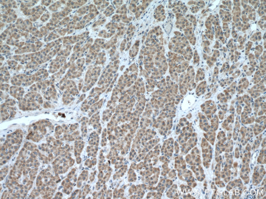 Immunohistochemistry (IHC) staining of human liver cancer tissue using CCDC71 Polyclonal antibody (28152-1-AP)