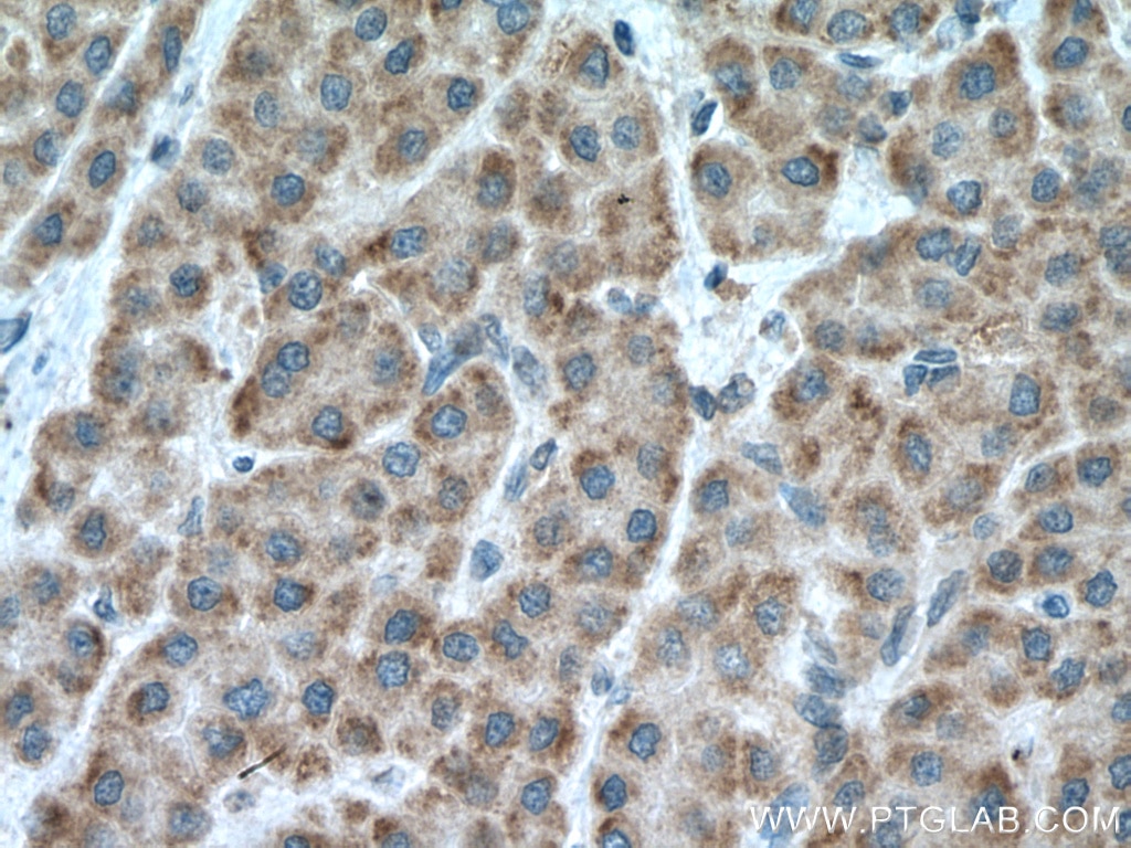 Immunohistochemistry (IHC) staining of human liver cancer tissue using CCDC71 Polyclonal antibody (28152-1-AP)