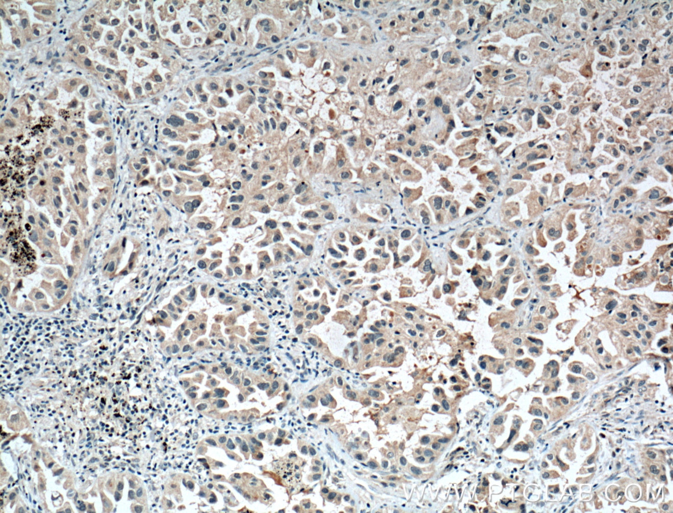 Immunohistochemistry (IHC) staining of human lung cancer tissue using CCDC8 Polyclonal antibody (27194-1-AP)