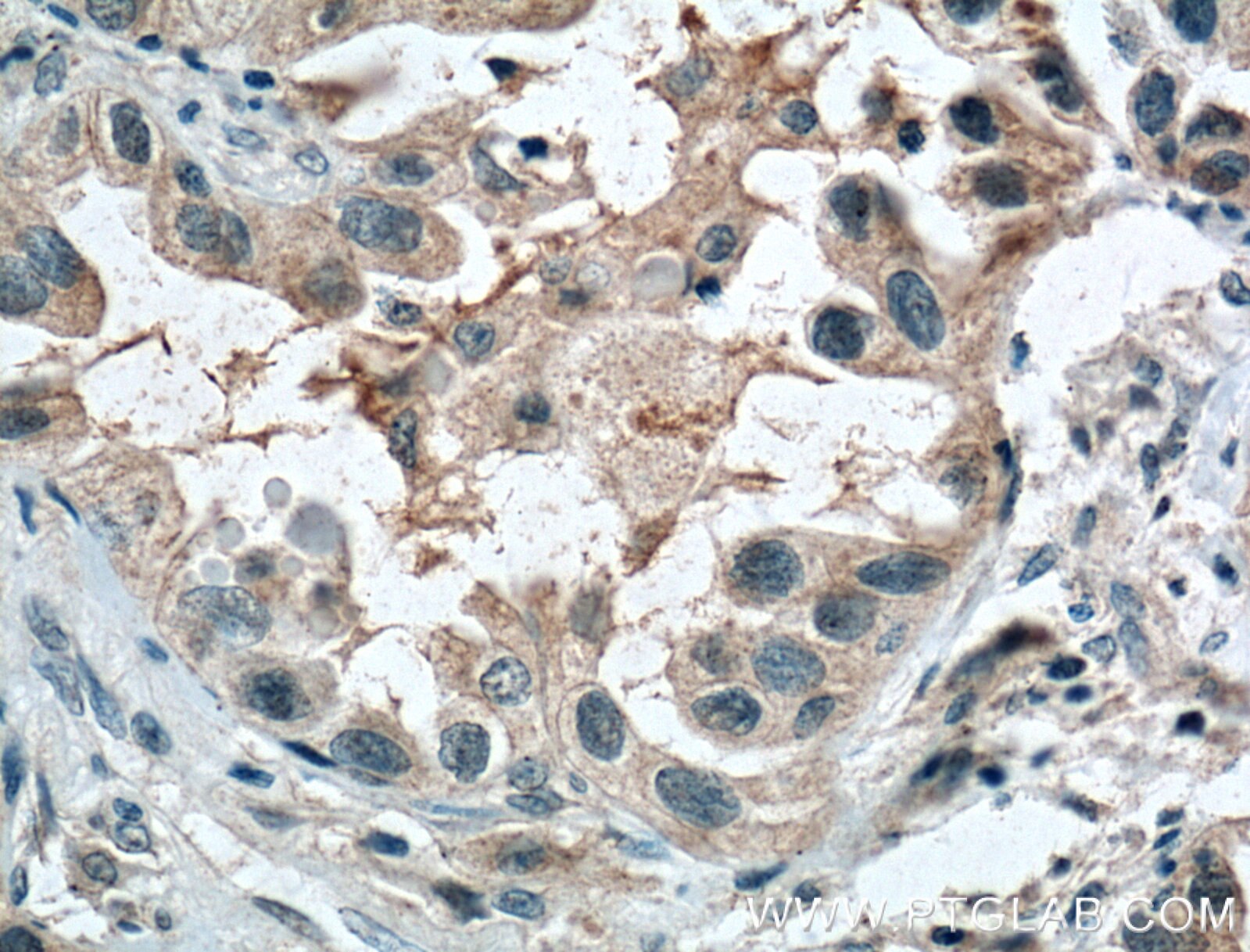 IHC staining of human lung cancer using 27194-1-AP