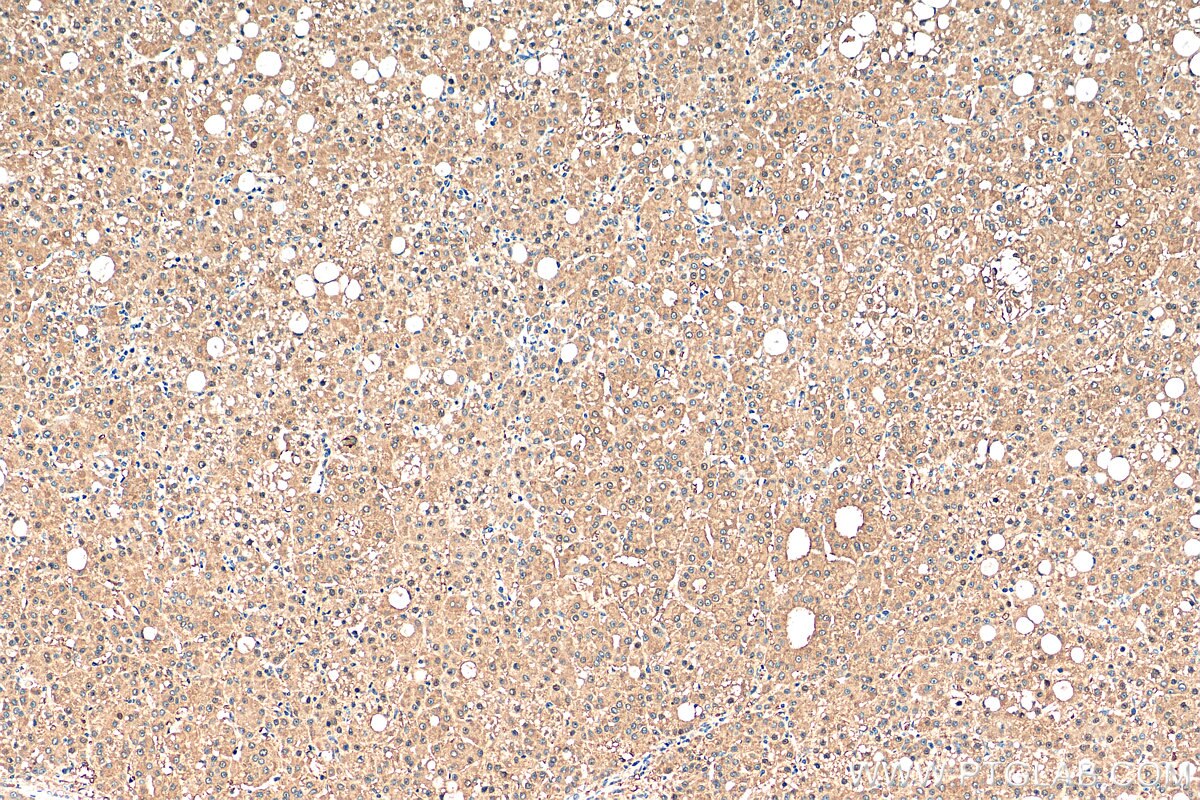 Immunohistochemistry (IHC) staining of human liver cancer tissue using CCDC99 Polyclonal antibody (24689-1-AP)