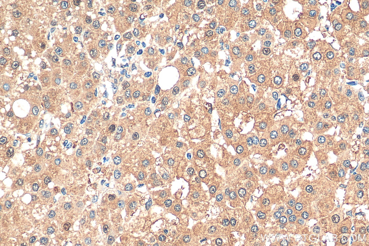 Immunohistochemistry (IHC) staining of human liver cancer tissue using CCDC99 Polyclonal antibody (24689-1-AP)