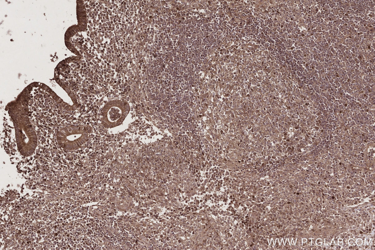 IHC staining of human appendicitis using 24689-1-AP Immunohistochemistry (IHC) staining of human appendicitis tissue using CCDC99 Polyclonal antibody (24689-1-AP)