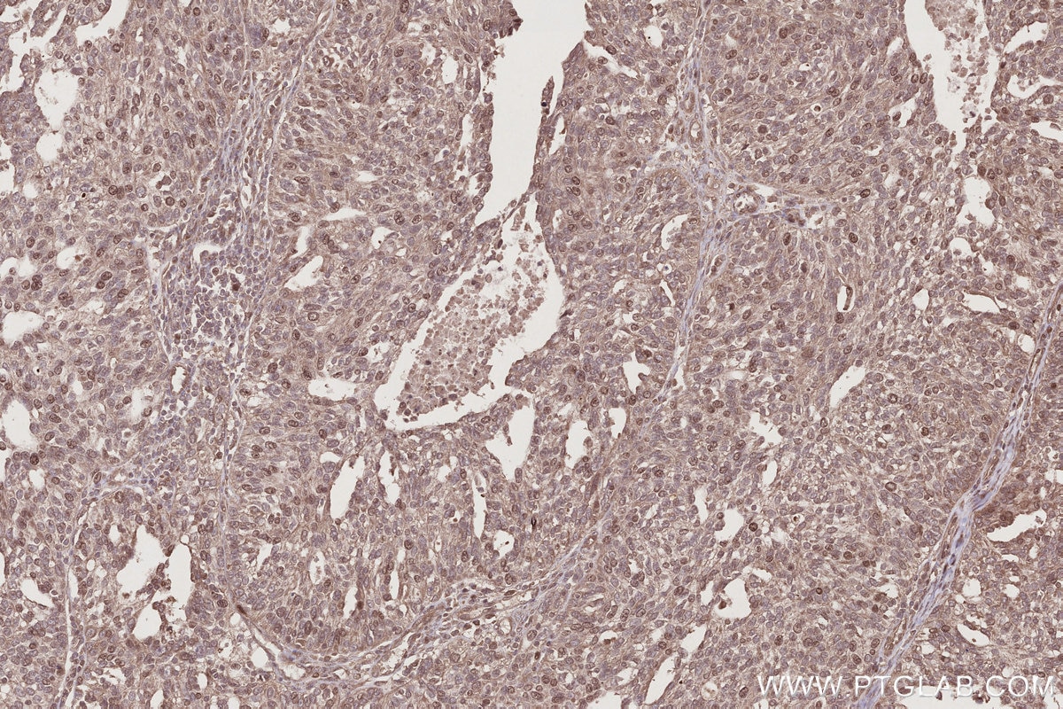 IHC staining of human ovary cancer using 24689-1-AP Immunohistochemistry (IHC) staining of human ovary cancer tissue using CCDC99 Polyclonal antibody (24689-1-AP)