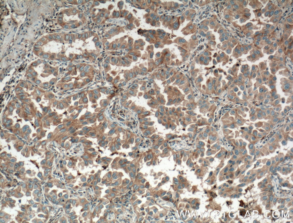 IHC staining of human lung cancer using 11786-1-AP
