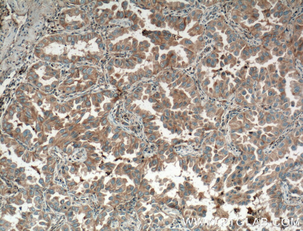 Immunohistochemistry (IHC) staining of human lung cancer tissue using Eotaxin Polyclonal antibody (11786-1-AP)