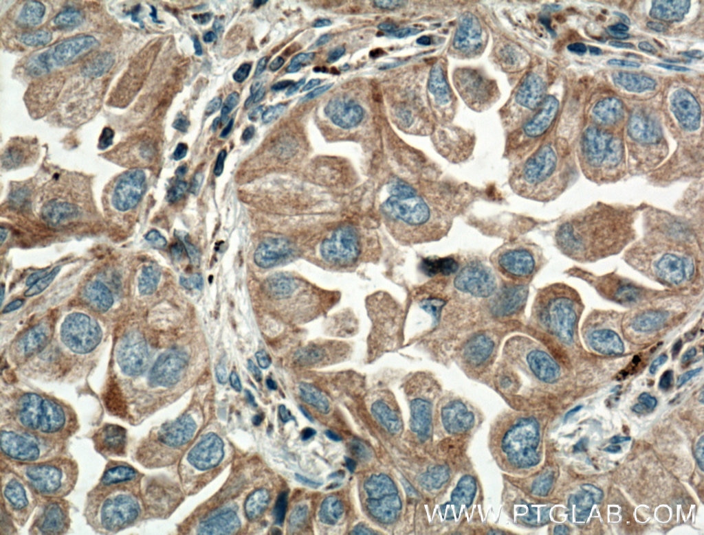 Immunohistochemistry (IHC) staining of human lung cancer tissue using Eotaxin Polyclonal antibody (11786-1-AP)