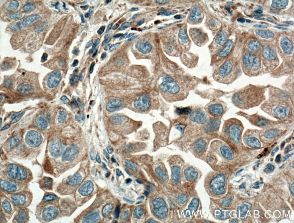 IHC staining of human lung cancer using 11786-1-AP