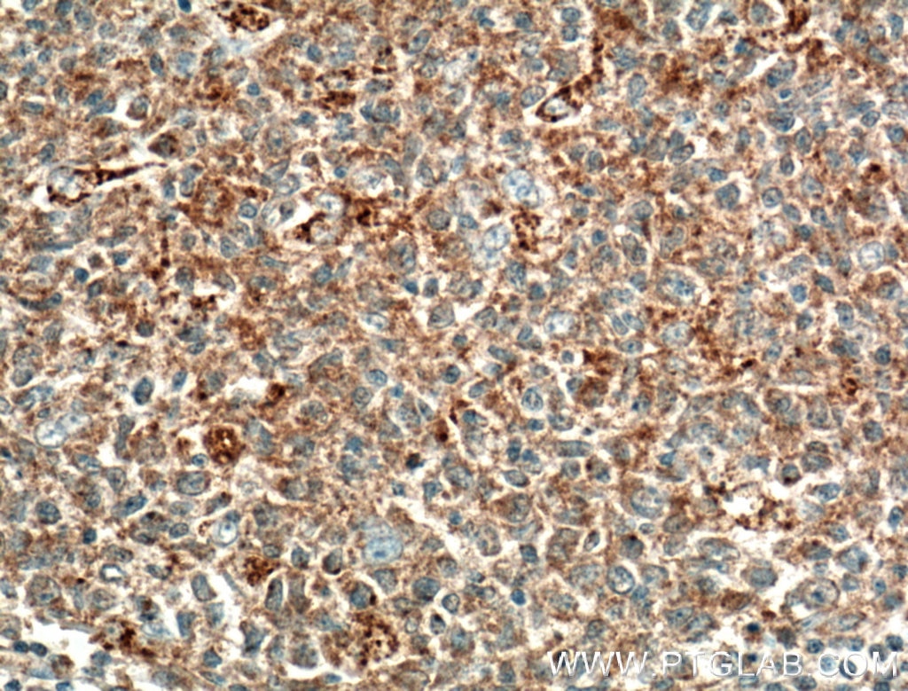 Immunohistochemistry (IHC) staining of human tonsillitis tissue using Eotaxin Polyclonal antibody (11786-1-AP)