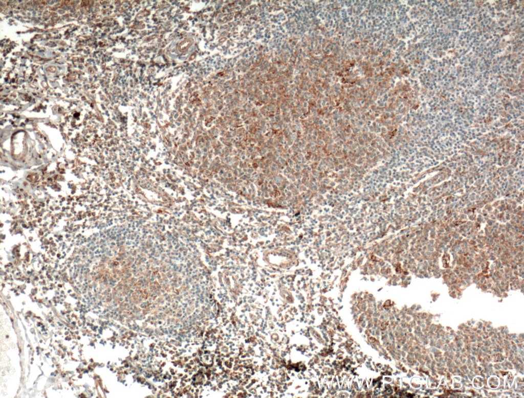 Immunohistochemistry (IHC) staining of human tonsillitis tissue using Eotaxin Polyclonal antibody (11786-1-AP)