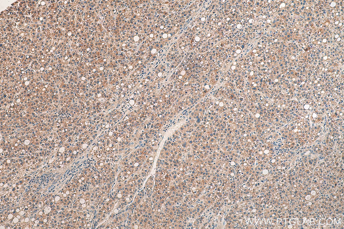 IHC staining of human liver cancer using 14216-1-AP