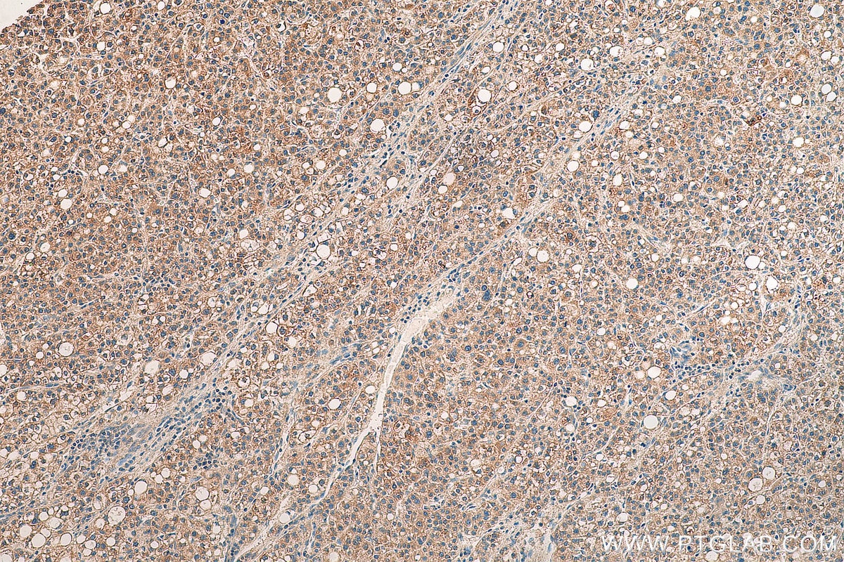 Immunohistochemistry (IHC) staining of human liver cancer tissue using CCL14 Polyclonal antibody (14216-1-AP)