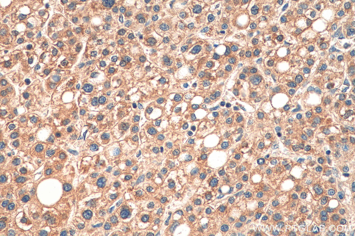 Immunohistochemistry (IHC) staining of human liver cancer tissue using CCL14 Polyclonal antibody (14216-1-AP)