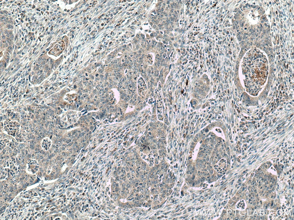 Immunohistochemistry (IHC) staining of human colon cancer tissue using CCL17 Polyclonal antibody (22342-1-AP)