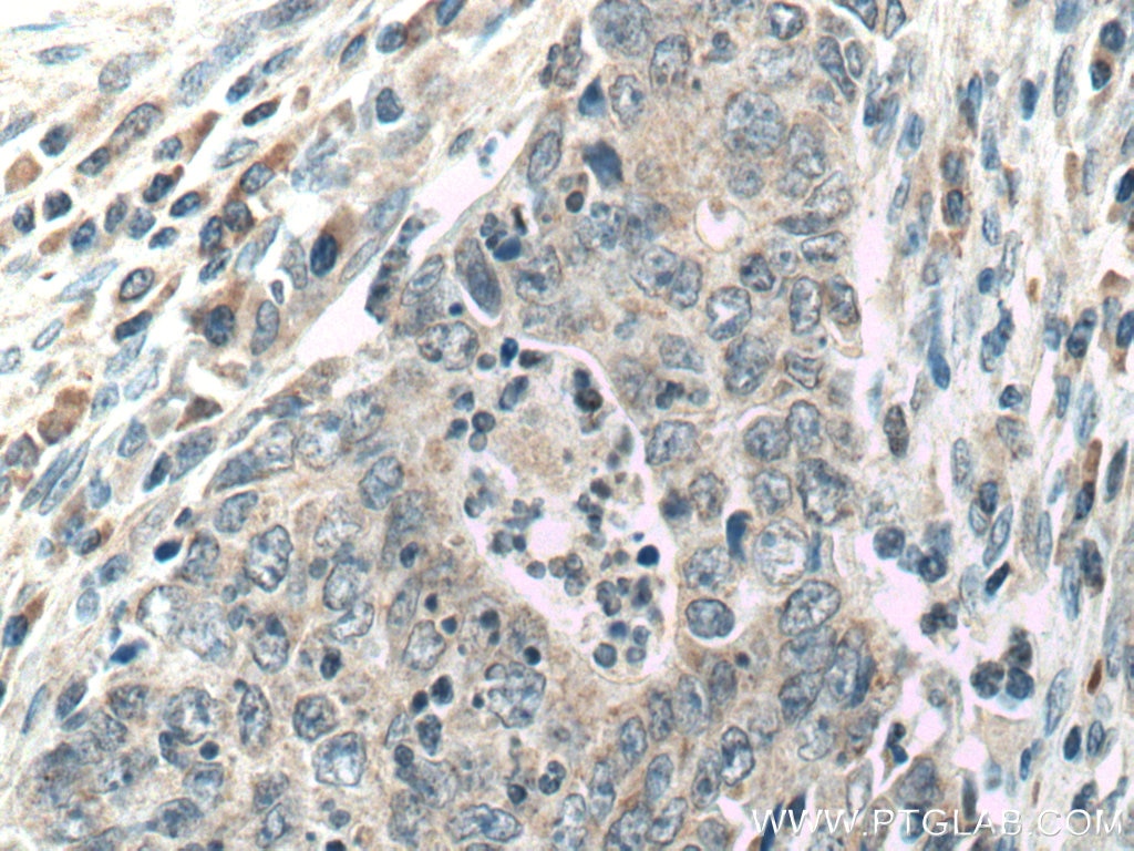 Immunohistochemistry (IHC) staining of human colon cancer tissue using CCL17 Polyclonal antibody (22342-1-AP)