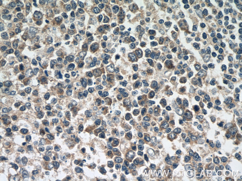 Immunohistochemistry (IHC) staining of human tonsillitis tissue using CCL18/MIP-4 Polyclonal antibody (22303-1-AP)