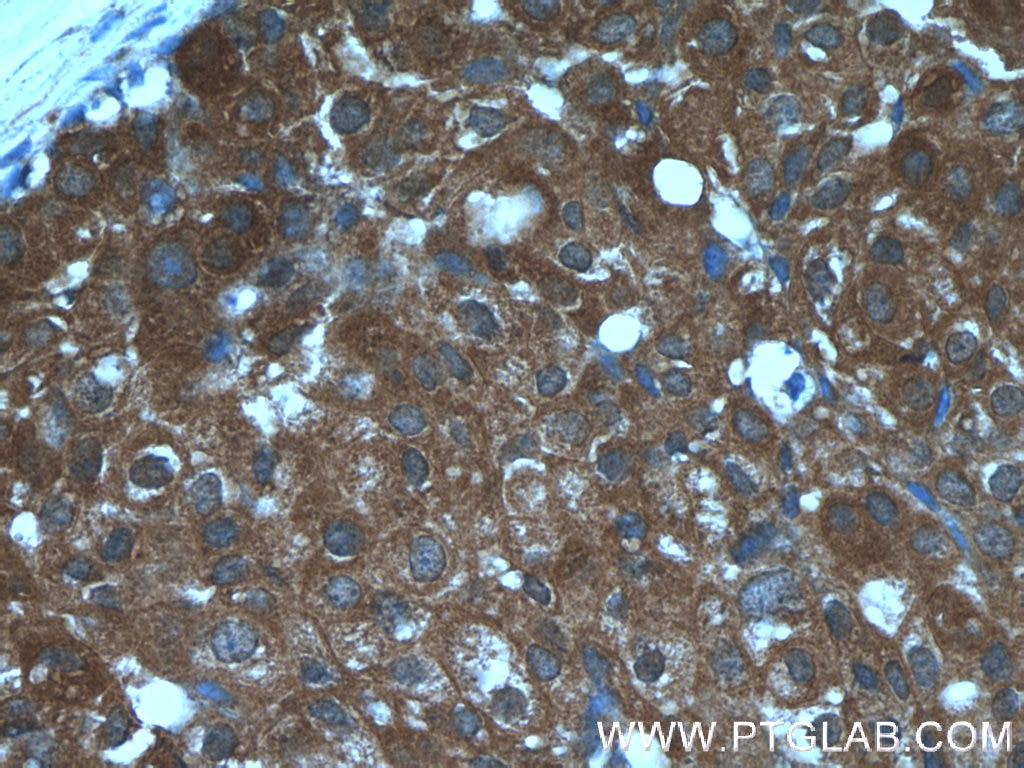 Immunohistochemistry (IHC) staining of human breast cancer tissue using CCL24/Eotaxin 2 Polyclonal antibody (22306-1-AP)