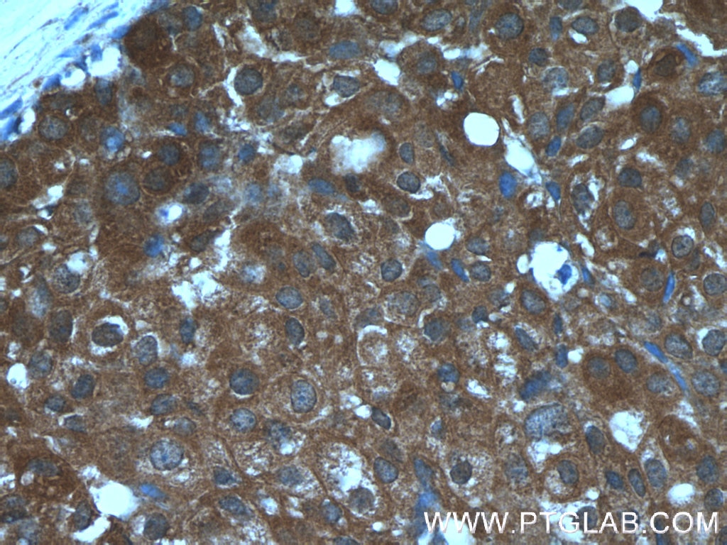 Immunohistochemistry (IHC) staining of human breast cancer tissue using CCL24/Eotaxin 2 Polyclonal antibody (22306-1-AP)